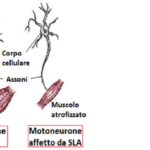 Immagine motoneurone affetto da Sla