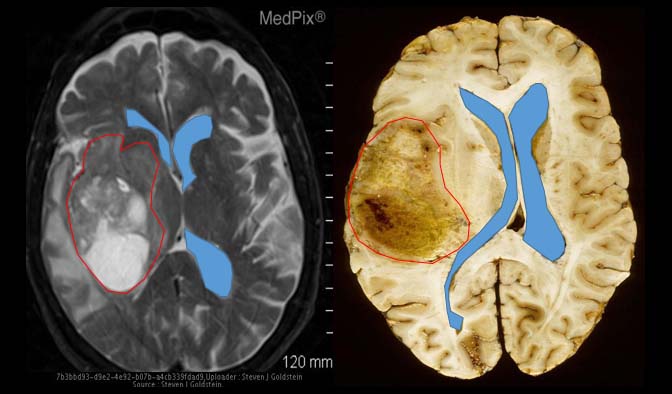 Come e perchè i macrofagi nutrono il glioblastoma invece di attaccarlo glioblastoma