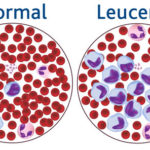 leucemia