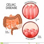 malattia-celiaca-piccoli-intestinale-con-i-villi-normali-e-villous-107750040