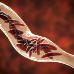 sickle-cell-GettyImages-1133641503-768x512