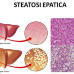 steatosi_epatica
