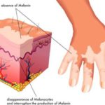 vitiligine-rimedi-naturali
