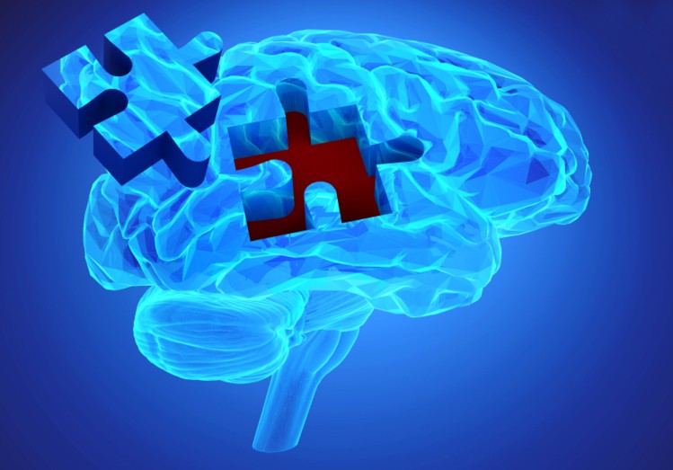 Come prevenire l’infiammazione cerebrale nell’Alzheimer alzheimer