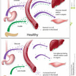 diabete-di-tipo-1-19063415