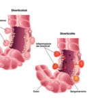 diverticoli_WEB