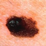 melanoma-638x425-1200x796