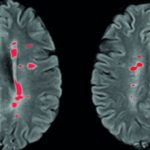 sclerosi-multipla-720x340