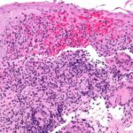 crohnsdisease