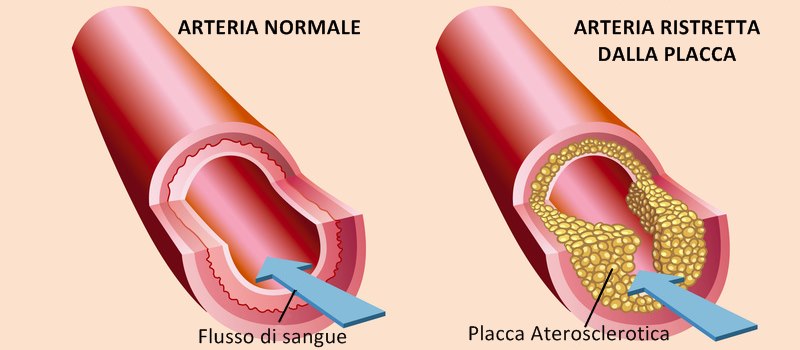 Aterosclerosi