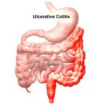 colite-ulcerosa-immagine
