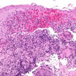 crohnsdisease