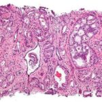 prostatecanc