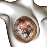 tumore-al-seno-638x425