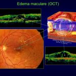 Edema maculare (OCT) Adattato da: Retinopatia Diabetica Del Prof. B. Lumbroso.