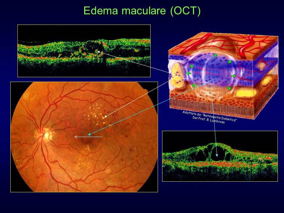 Edema maculare (OCT) Adattato da: Retinopatia Diabetica Del Prof. B. Lumbroso.