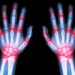 artrite_reumatoide_molecola_infiammazione