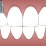 dentalimplant