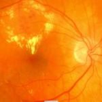 edema_maculare_in_retinopatia_diabetica-web