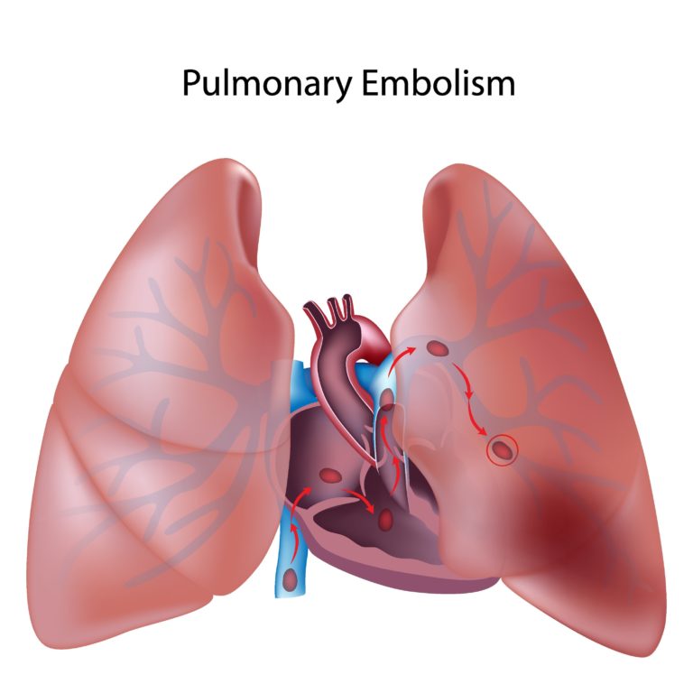 Embolia polmonare: quanto sono sicuri ed efficaci i nuovi dispositivi? embolia polmonare