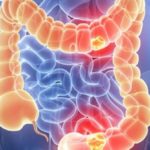 tumore colon