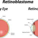 32265874 - retinoblastoma labeled diagram