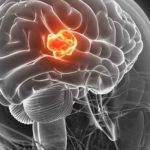 gliopblastoma_54761