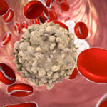 leucemia linfatica cronica_thumb_720_480