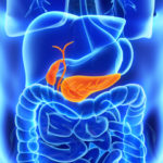 pancreatiteacuta2