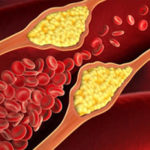 Aterosclerosi-angina-infarto_dx