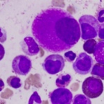 Leucemia_Acuta_Mieloide