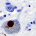 parkinsonsdi