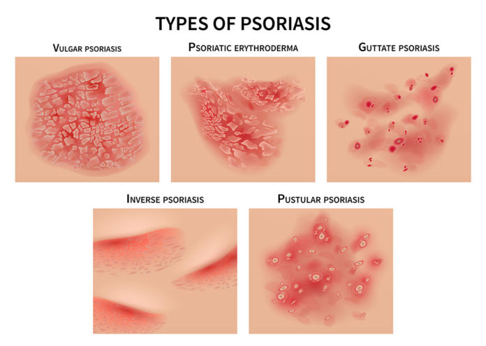 psoriasi