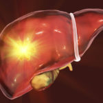 tumore-fegato
