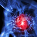 infarto_miocardico_acuto_14641