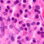 multiplemyel