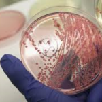 Escherichia_coli_peritonite_batterica_spontanea.jpg_92221