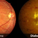Retinopatia_diabetica