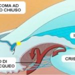 glaucoma-angolo-chiuso-300x183