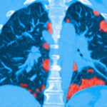 041720_dc_covid-lungs_feat-1028x579