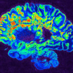 111519_sb_multiple-sclerosis_feat-1028x579