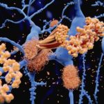 Alzheimer's disease: the amyloid-beta peptide accumulates to amy