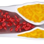 what-is-peripheral-arterial-disease-PAD-4-600x360