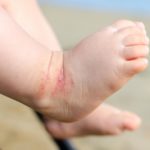 atopic dermatitis newborn feet eczema