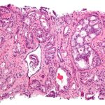 Prostate_cancer_with_Gleason_pattern_4_low_mag