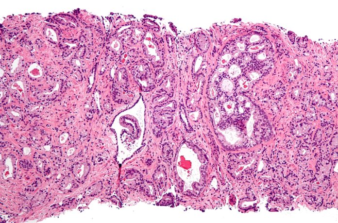 Prostate_cancer_with_Gleason_pattern_4_low_mag