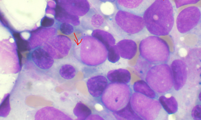 myeloidleuke