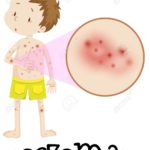 Human Medical Education of Eczema