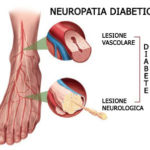 piede-diabetico