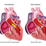 valvola-aortica